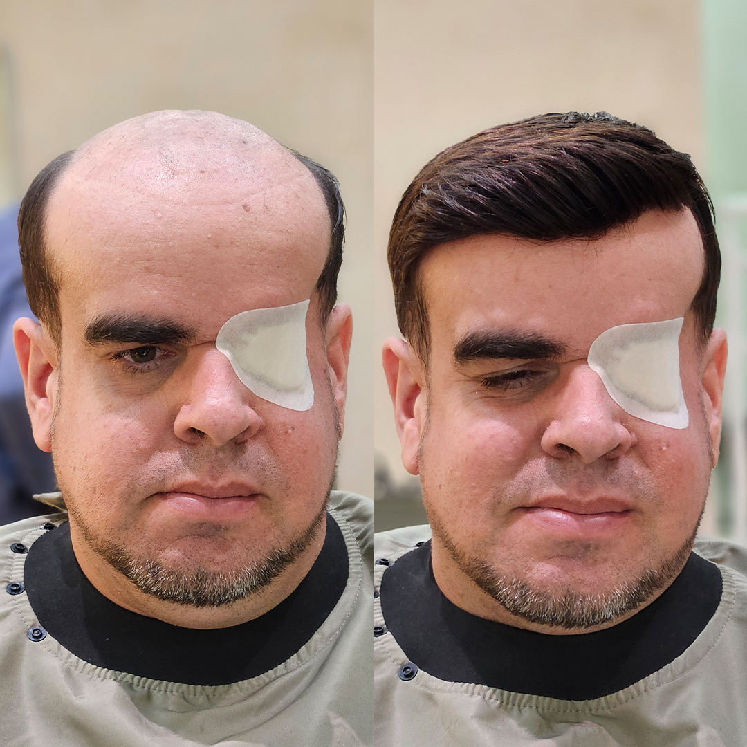 Resultado de prótese capilar Revolux