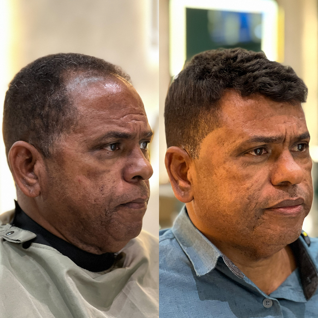 Resultado de prótese capilar Revolux