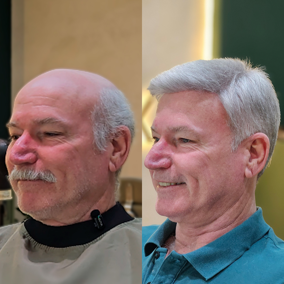 Resultado de prótese capilar Revolux