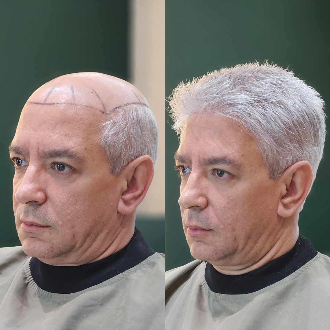 Resultado de prótese capilar Revolux